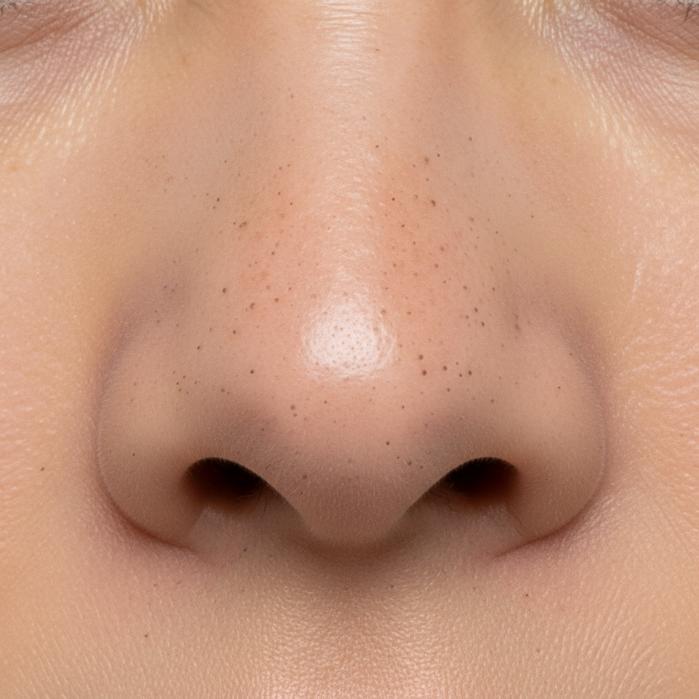 Solara Glow - Before Nose Blackheads